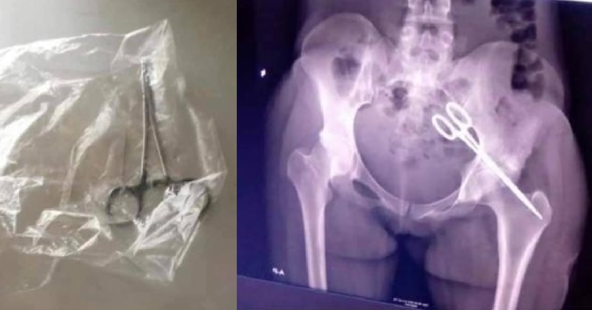 Scissors Removed From Patient’s Stomach After 7 Years