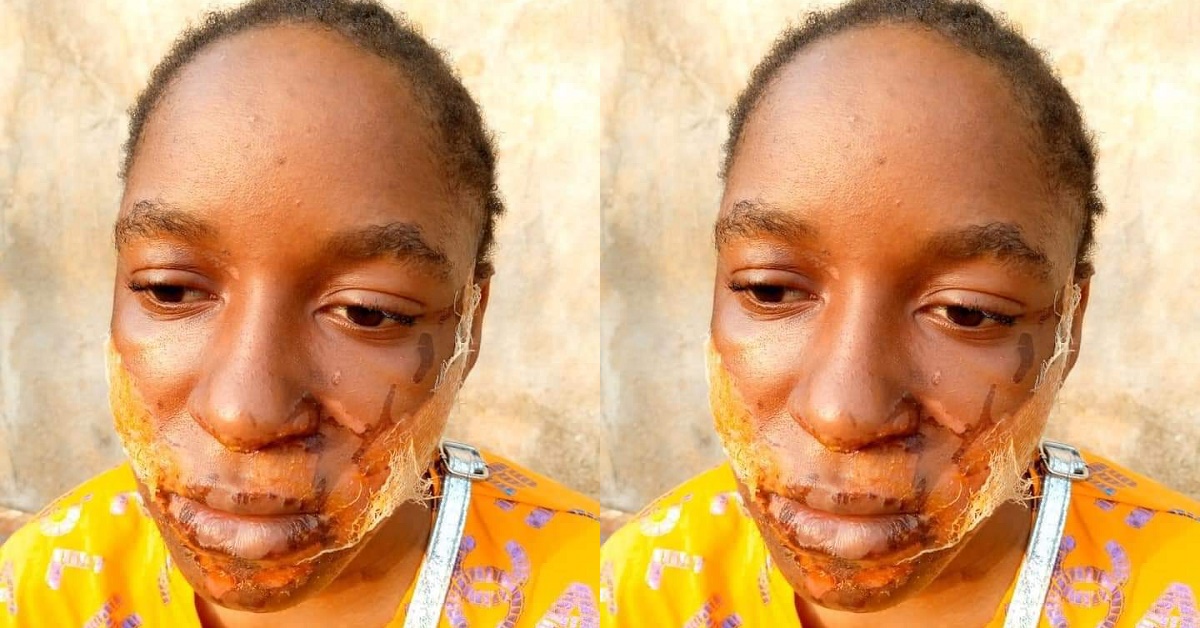 17-Year-Old Lady Who Was Beaten And Face Damaged With Acid Pleads For Help to Get Justice