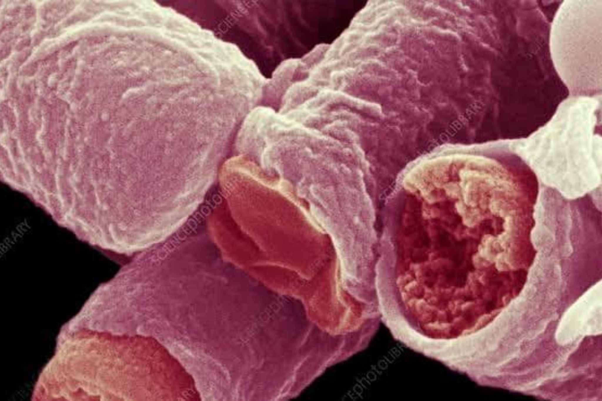 Sierra Leone Government Confirms Outbreak of Anthrax Disease