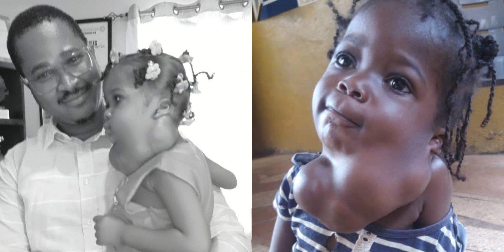 Sick Pikin Project Raising $15,900 for 3 Years Old Umu George Surgery