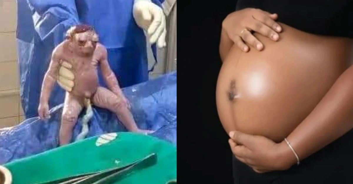 After 29 Months, Woman Tragically Puts to Bed Anencephaly Baby in Sierra Leone