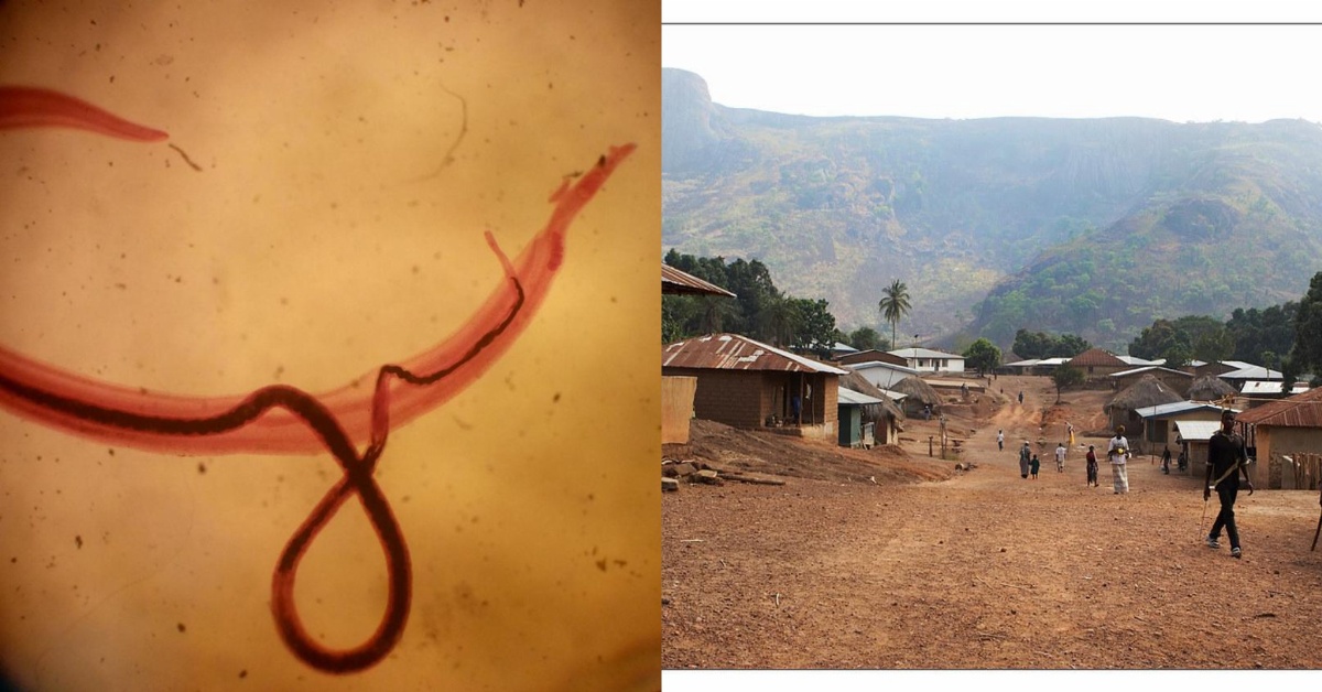 Over 100 Children Infected With Worm Disease in Northern Sierra Leone
