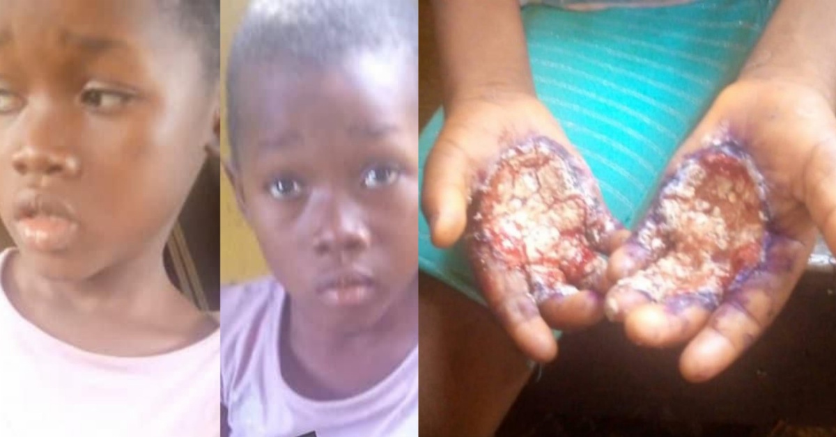 5-Year-Old Boy Gets Hands Burnt For Stealing Rice