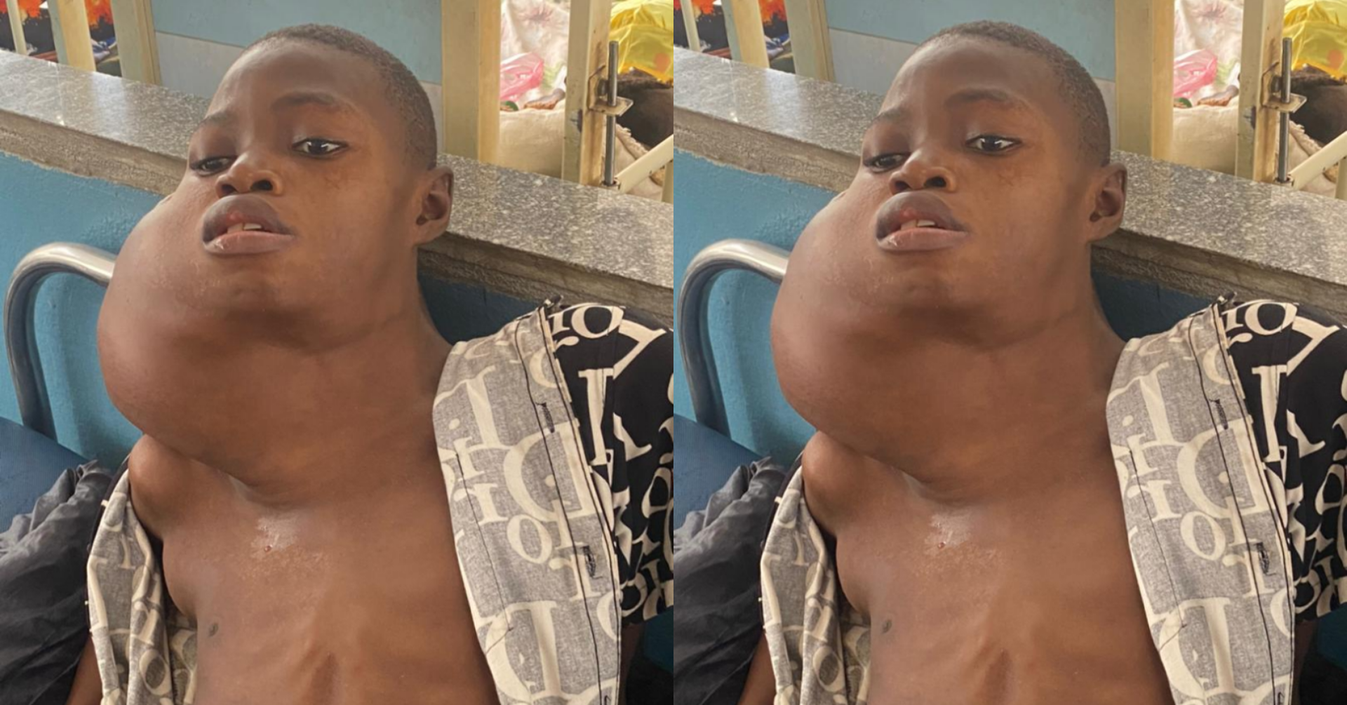 Boy With Giant Neck Tumor Cries For Help