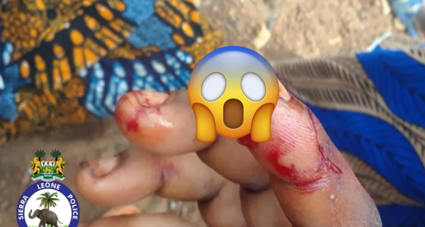 Woman Bites Off Co-Tenant’s Finger in Freetown