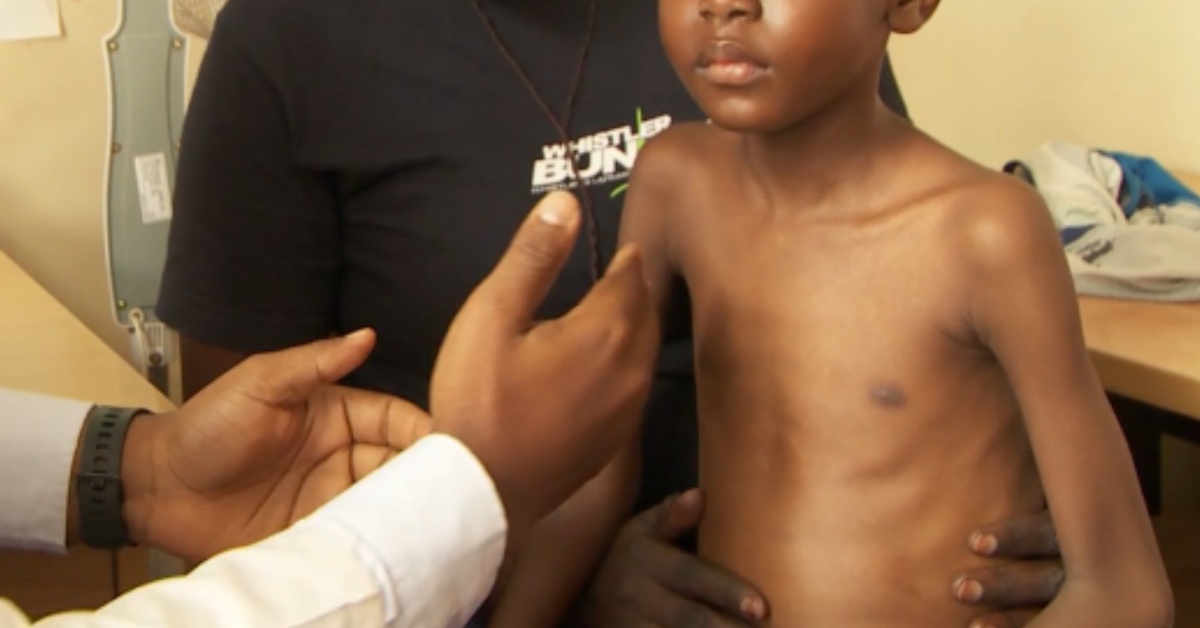 Children Diagnosed With Tuberculosis Surge in Bombali District 