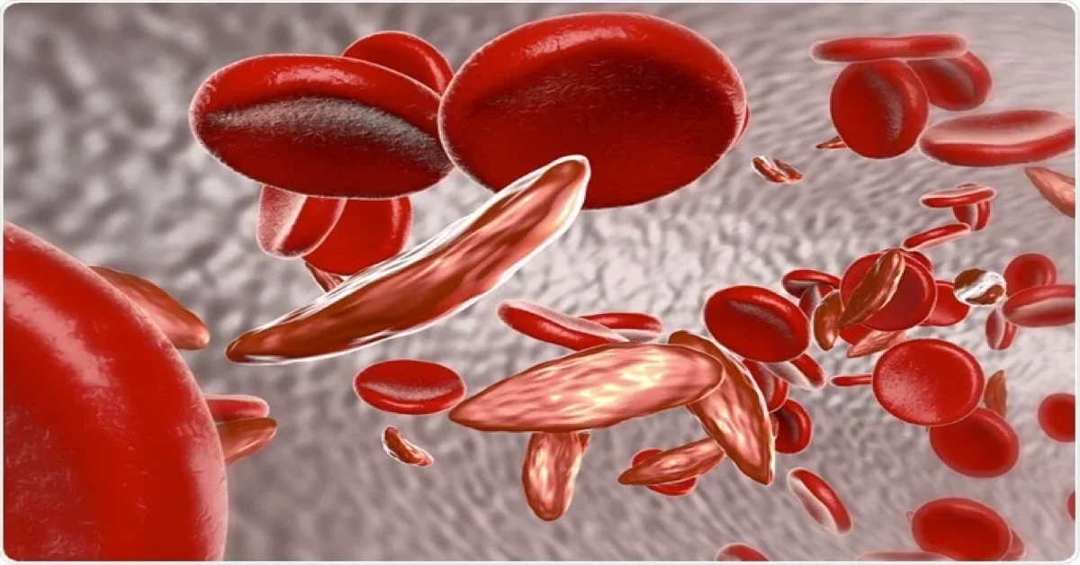 Over 4,000 Sierra Leoneans Affected With Sickle Cell Disease