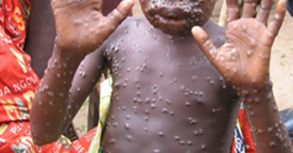 Early Signs of Monkeypox: What to Look Out For