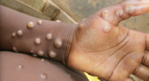 Sierra Leone Urges Precaution, Implements Preventive Measures Against MonkeyPox