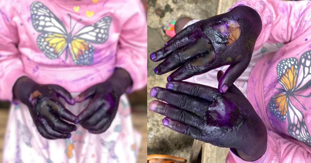 Aunt Burns Hands of 6-year-old After Wasting Baby Perfume