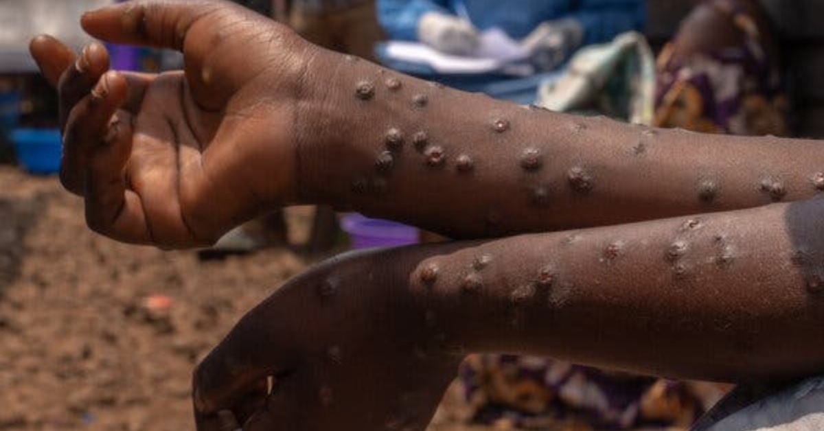 Sierra Leone Increases Surveillance After Guinea Records First Mpox Case