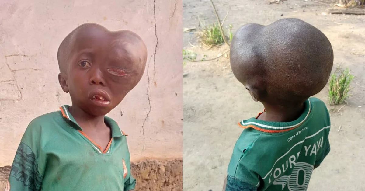 15-Year-Old Boy in Simiria Chiefdom With Health Complications Cries for Help