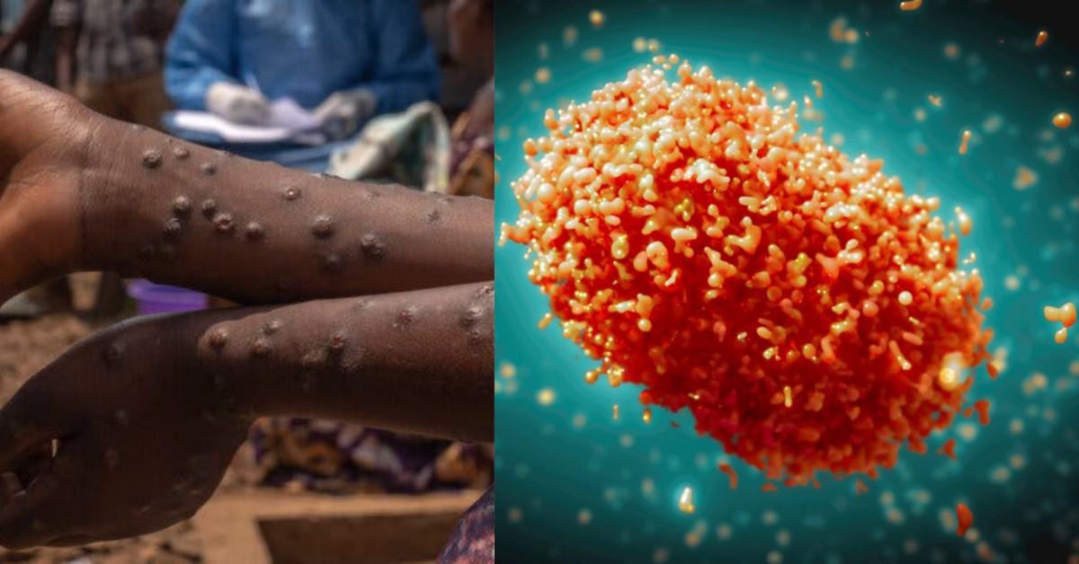 Mpox Update: Sierra Leone Records 14 New Cases and 14 Total Deaths