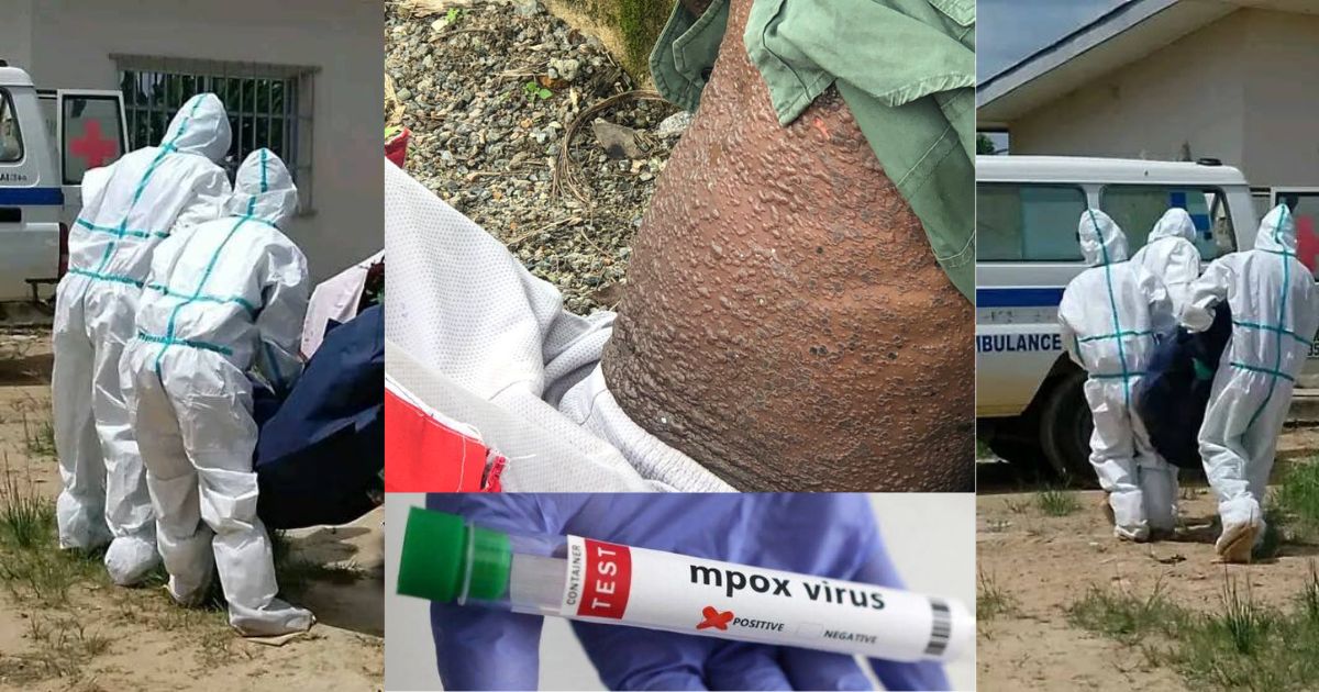 Sierra Leone Records 75 New Mpox Cases, 219 Recoveries in Latest Update
