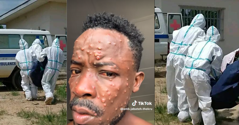 Sierra Leone Records 53 New Mpox Cases, 74 Recoveries And 25 Deaths
